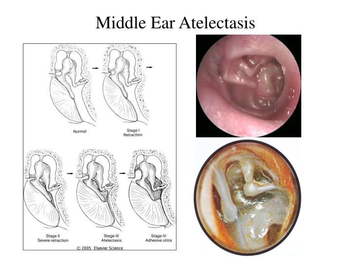 PPT Chronic Otitis Media with and without Cholesteatoma
