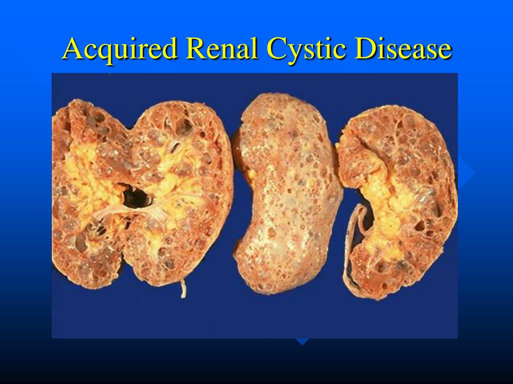 presentation of renal cyst