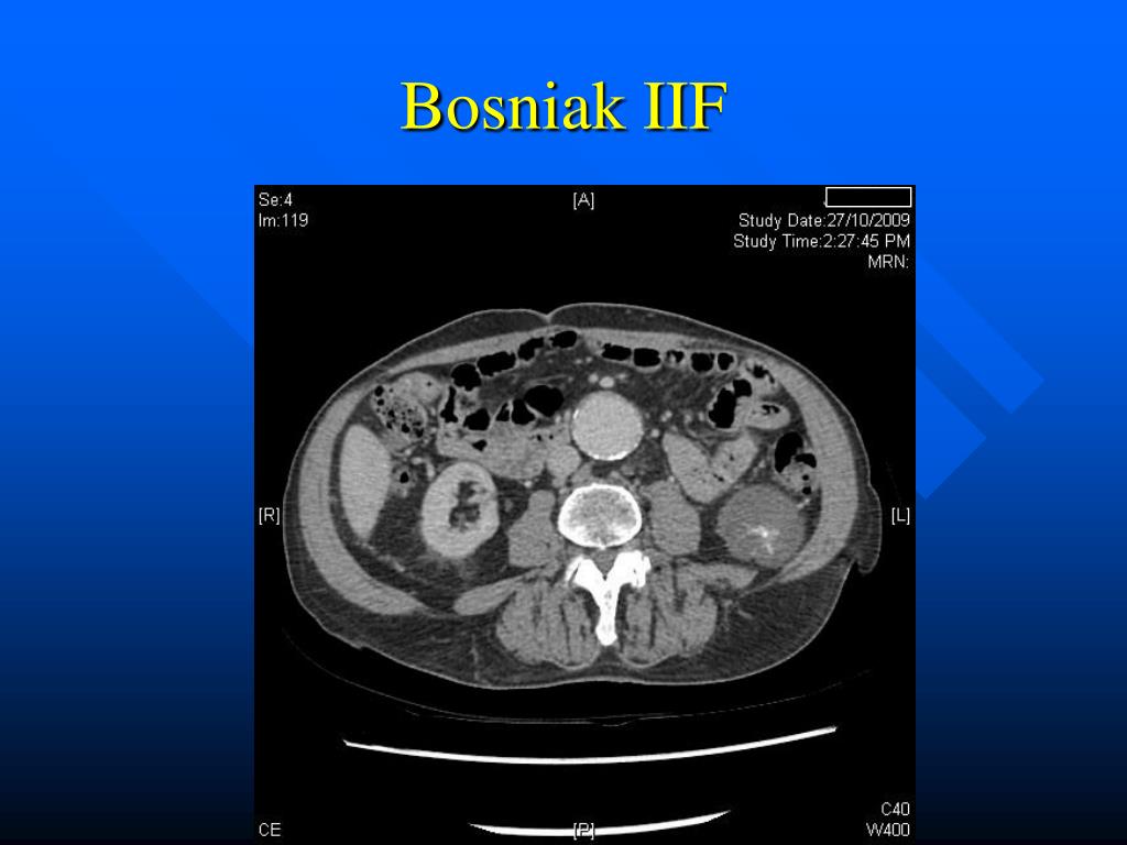 PPT - Renal Cystic Disease PowerPoint Presentation, free download - ID ...