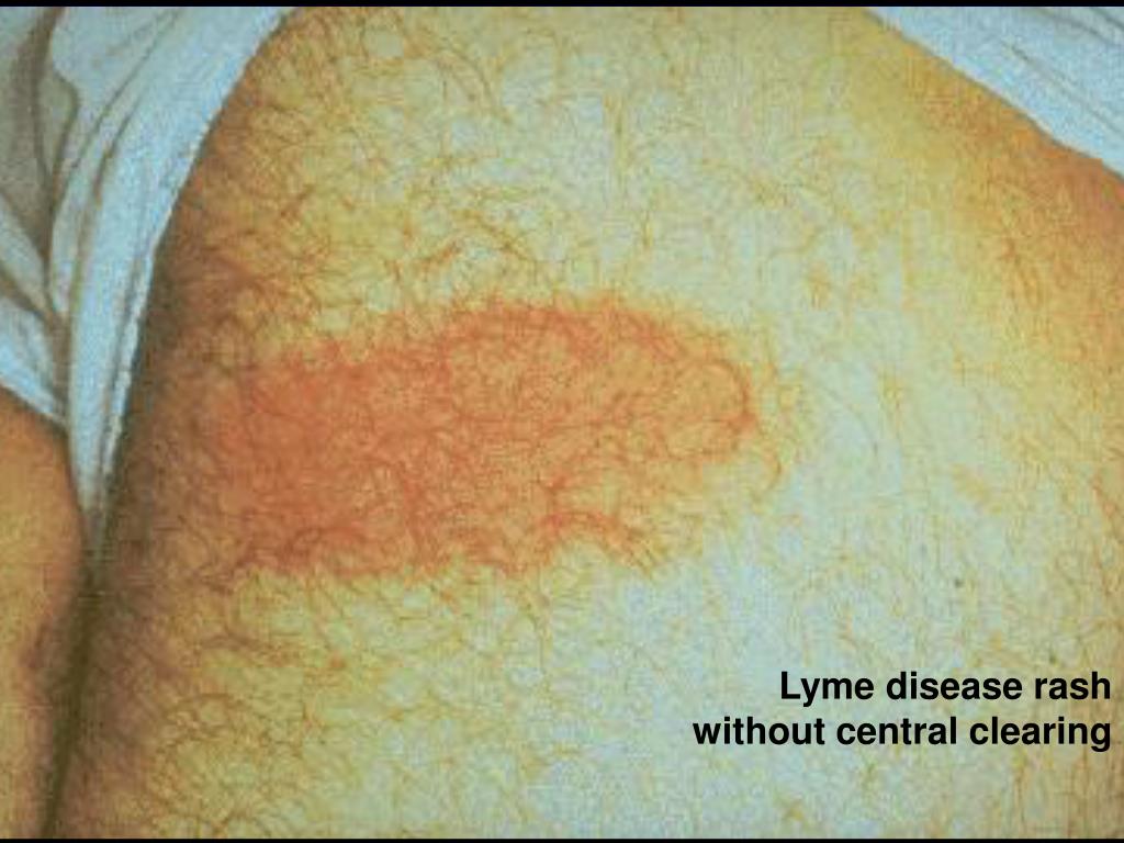 PPT What You Should Know About Lyme Disease and Other TickBorne Diseases PowerPoint