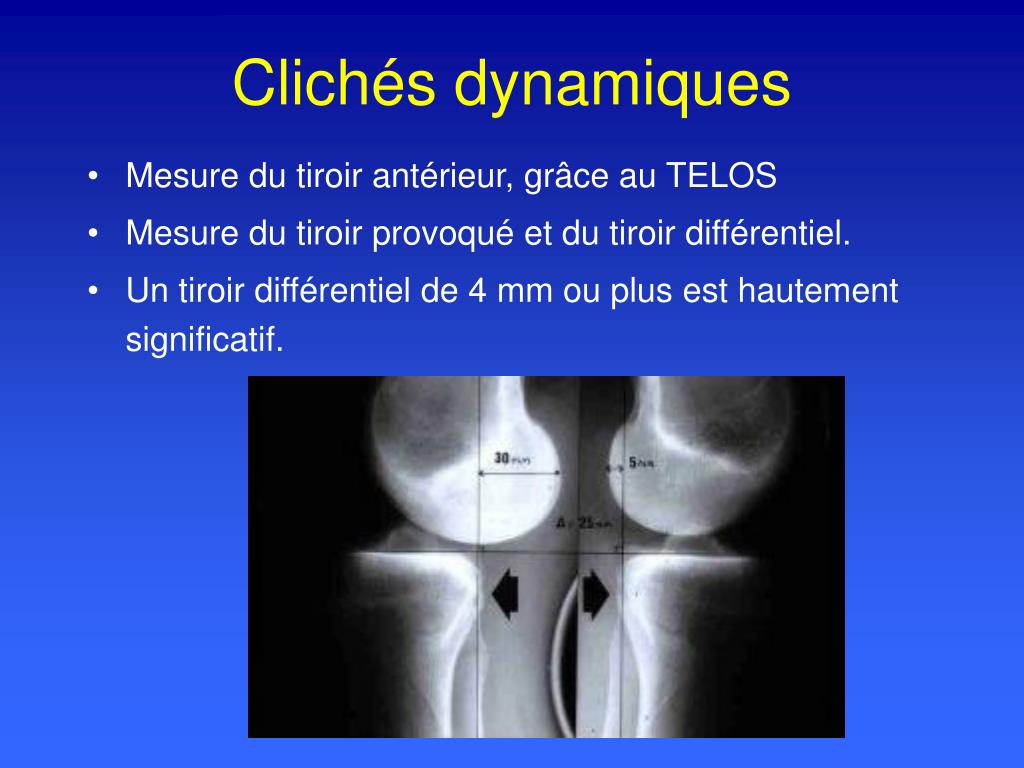PPT - Imagerie du genou PowerPoint Presentation, free download - ID:1278470