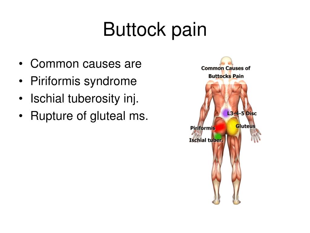 What Is Deep Gluteal Syndrome How Is It Treated vrogue.co