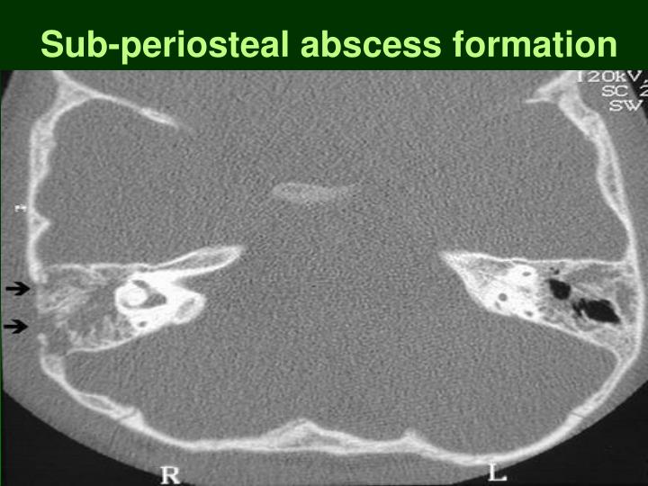 PPT Acute Suppurative Otitis Media PowerPoint Presentation ID1287636