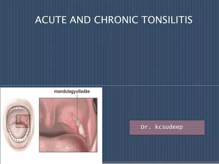 acute and chronic tonsilitis n.
