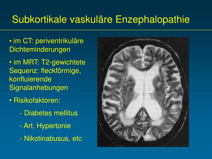 Vaskuläre Leukenzephalopathie Was Bedeutet Das www.slideserve.com