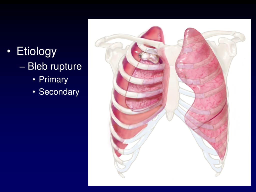 PPT VATS Treatment of Spontaneous Pneumothorax PowerPoint