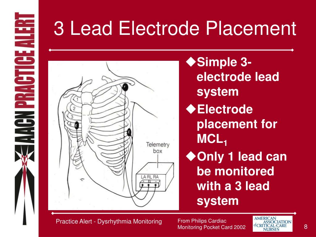 Lead placement monitoring telemetry Troubleshooting ECG