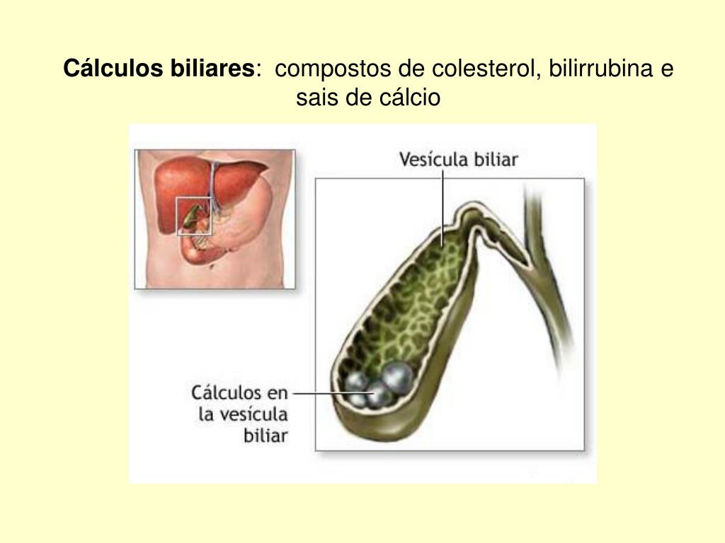 Calculos biliares dieta