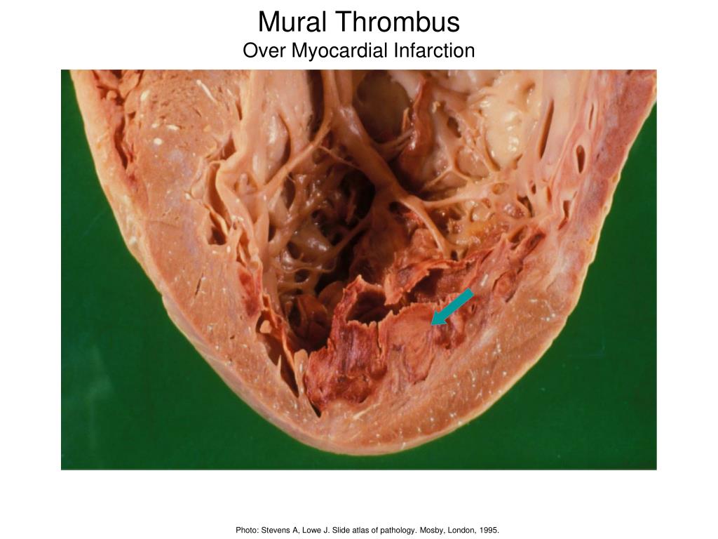 Ppt Hemodynamic Disorders Thrombosis And Shock Powerpoint Presentation Id Ppt Hemodynamic Disorders Thrombosis And Shock Powerpoint Presentation Id