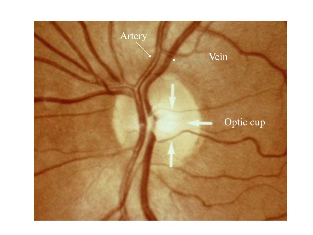 PPT Identify Vein, artery, disc, optic cup, fovea PowerPoint