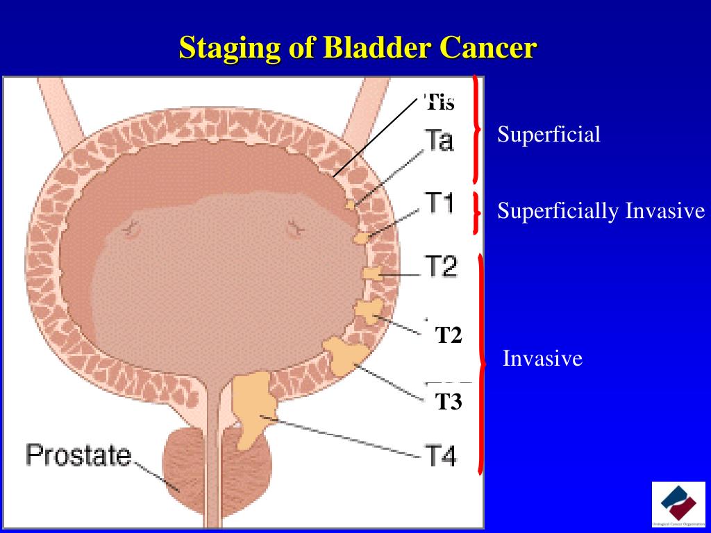Staging in Oncology. Gall bladder Cancer in Chile. Рак мочевого отзывы