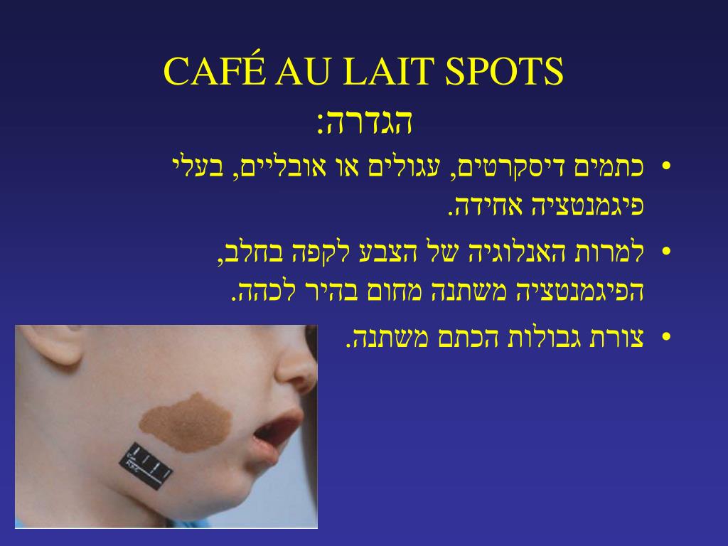 PPT CAF AU LAIT SPOTS DIFFERENTIAL DIAGNOSIS PowerPoint ppt-caf-au-lait-spots-differential-diagnosis-powerpoint