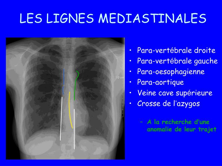 Silhouette Cardio Médiastinale Dans Les Limites De La Normale
