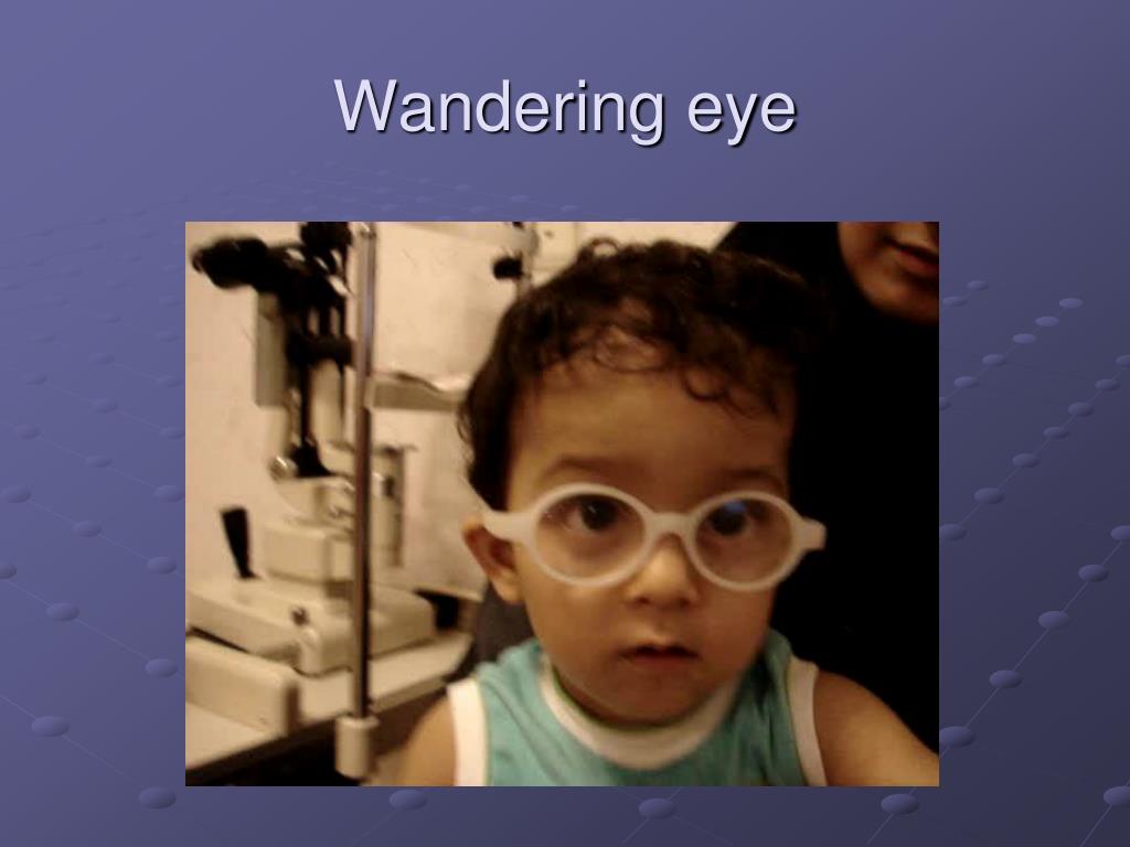 wandering eye in baby