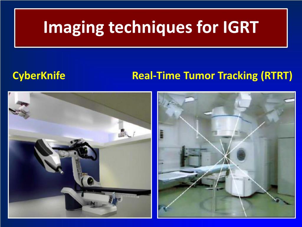 Ppt The External Beam Radiotherapy And Image Guided Radiotherapy 2