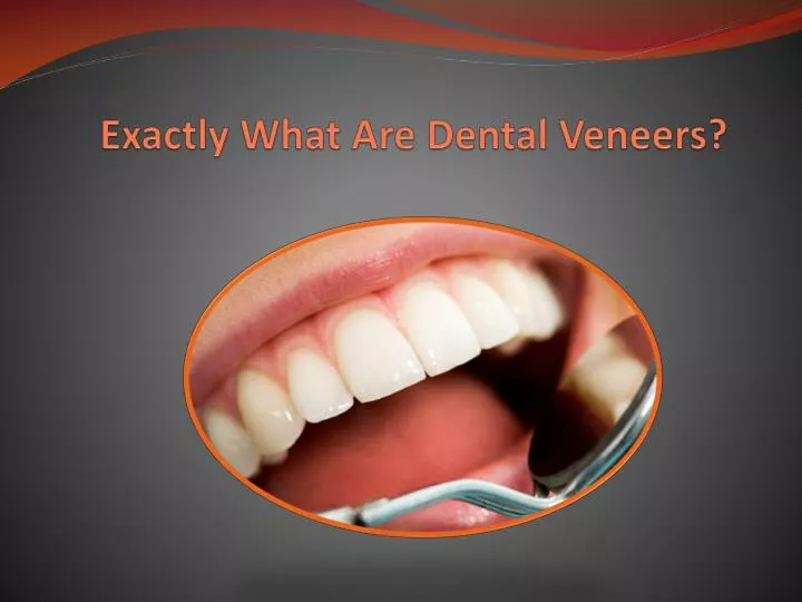 exactly what are dental veneers n.