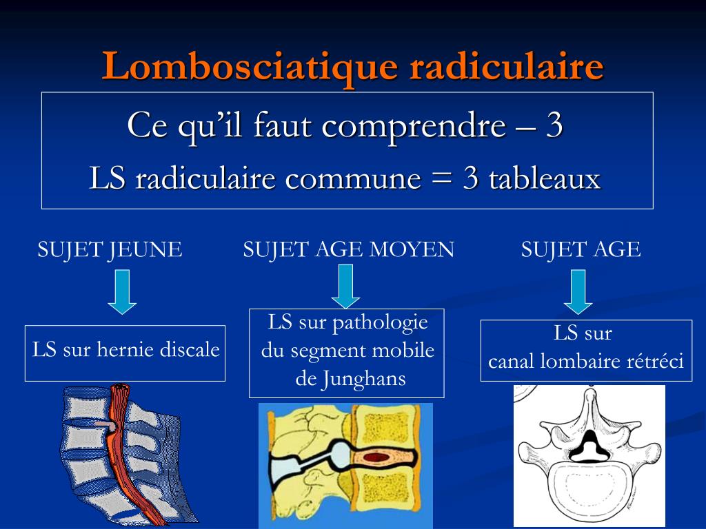Quels sont les différents types de lombosciatiques