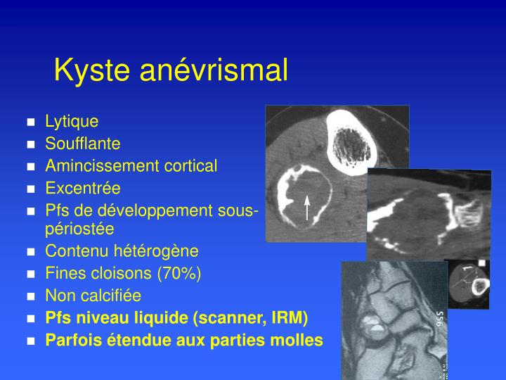 Kayste Kyste Osseux Anévrysmal , Pathology Outlines – HKVZU