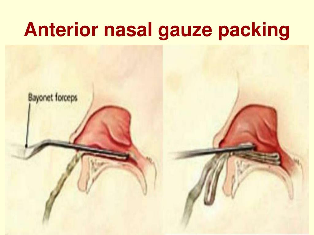 PPT Epistaxis PowerPoint Presentation, free download ID1364903