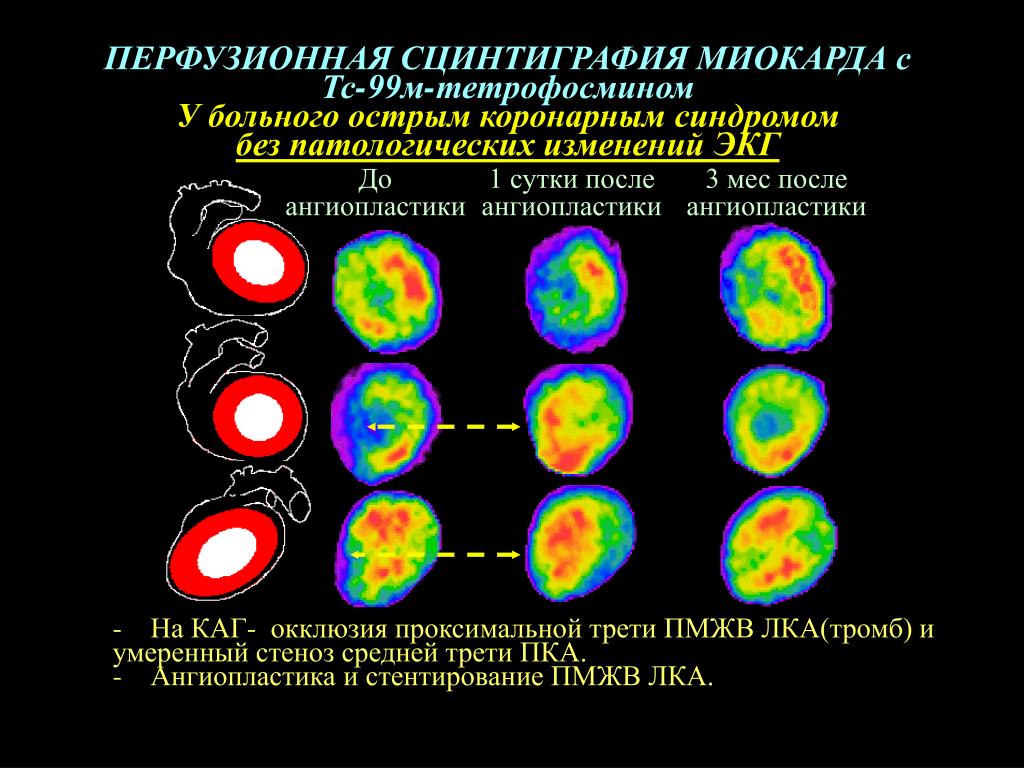 Сцинтиграфия это. Сцинтиграфия очага инфаркта миокарда. Сцинтиграфия очага некроза миокарда. Радиоизотопное исследование перфузии миокарда. Радиоизотопная сцинтиграфия миокарда.