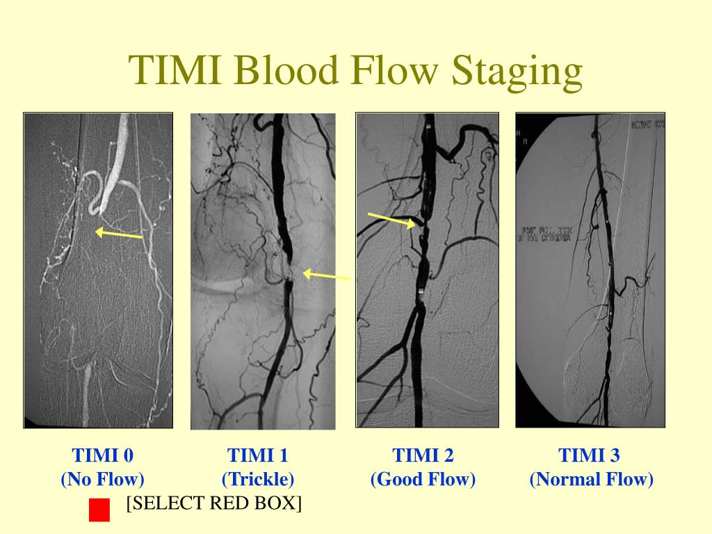 timi flow classification timi flow classification