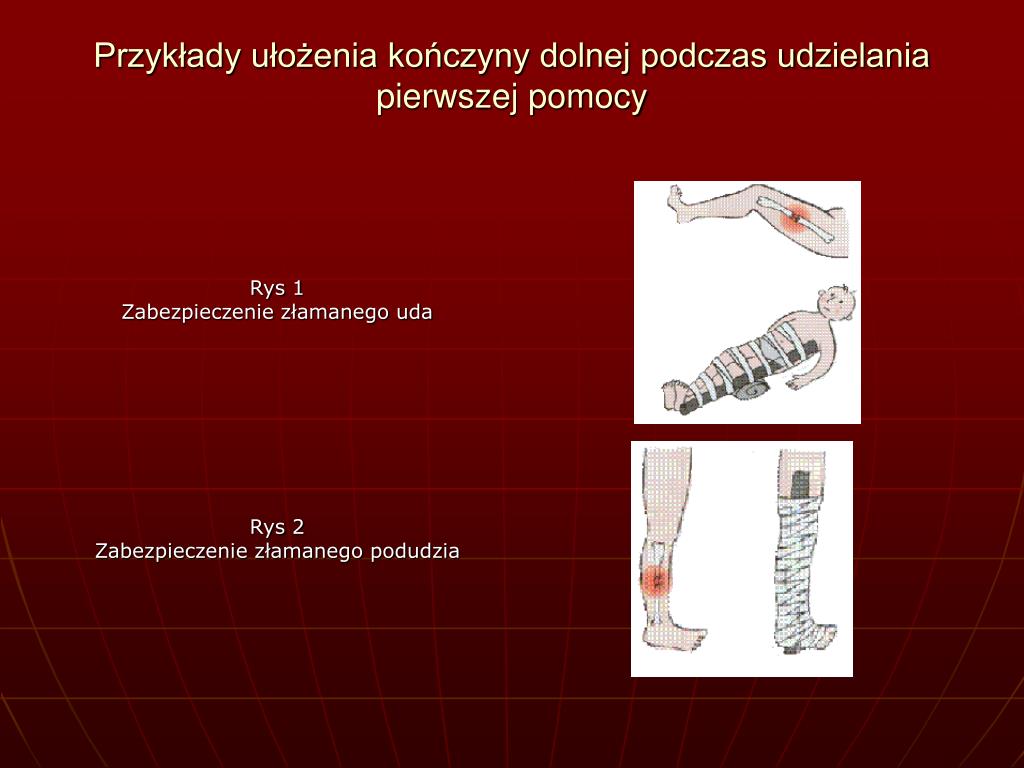 W Przypadku Złamania Kończyny Należy Unieruchomić Dwa Najbliższe Stawy PPT - Pierwsza Pomoc PowerPoint Presentation, free download - ID:137748