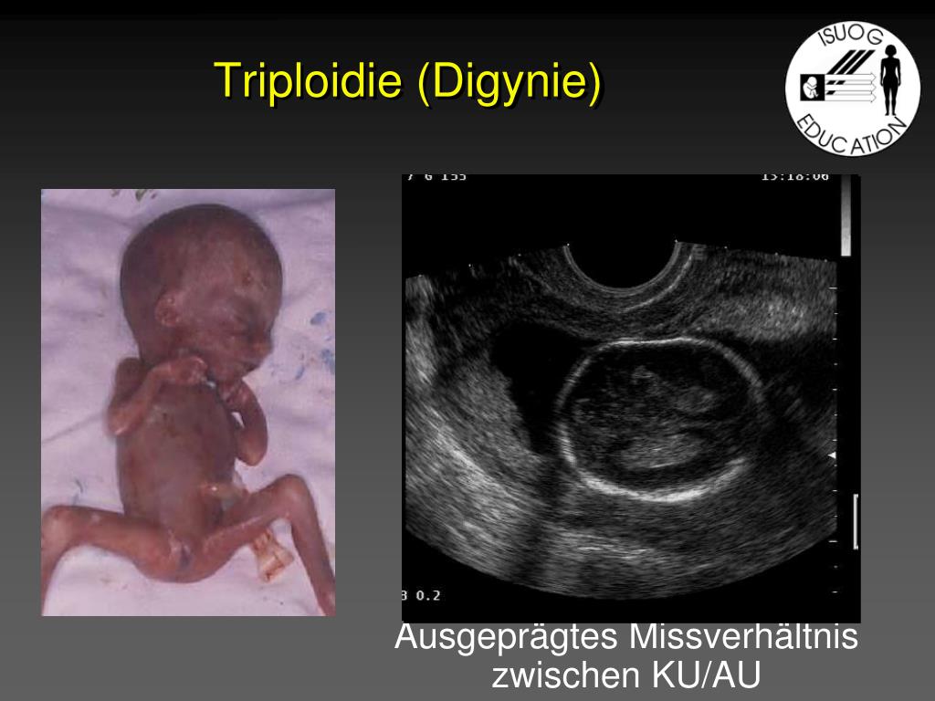PPT - Fetal Syndromes in Prenatal Diagnosis - Challenges and Markers ...