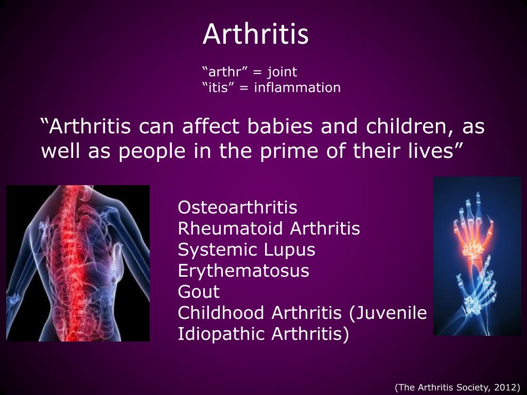 PPT Rheumatoid Arthritis Osteoarthritis & Systemic Lupus