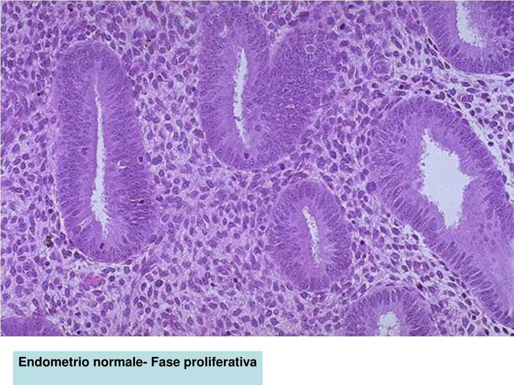 malattia fibrocistica di tipo proliferativo con iperplasia duttale florida