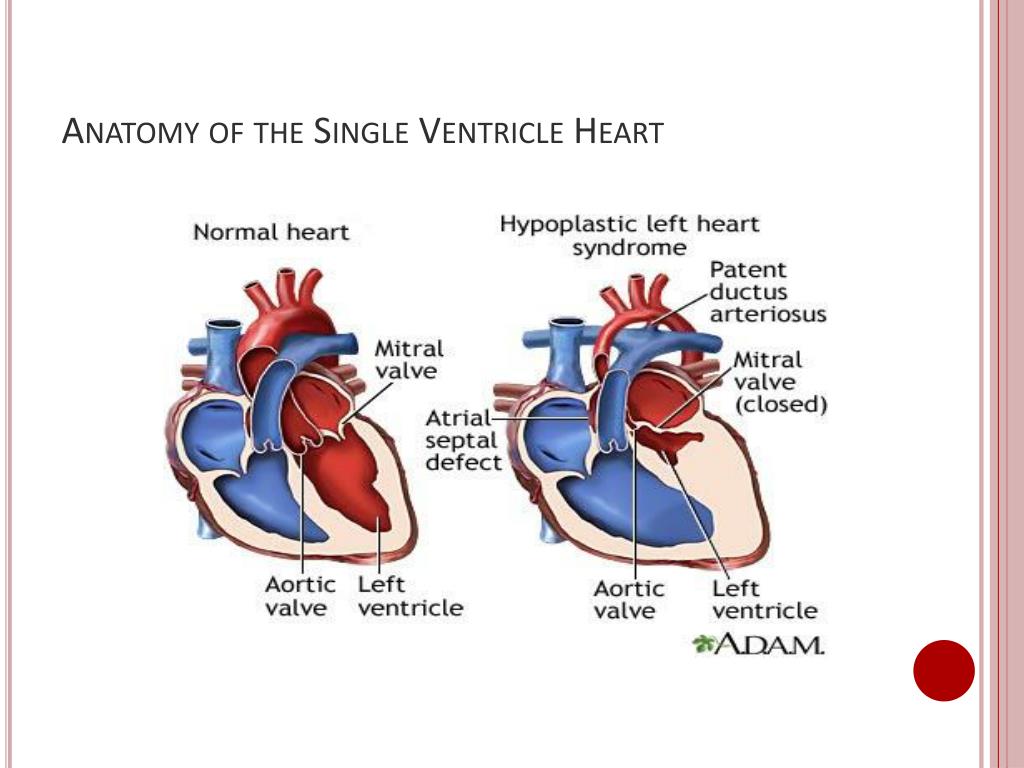 PPT - Improving Interstage Growth in Single Ventricle Heart Defects