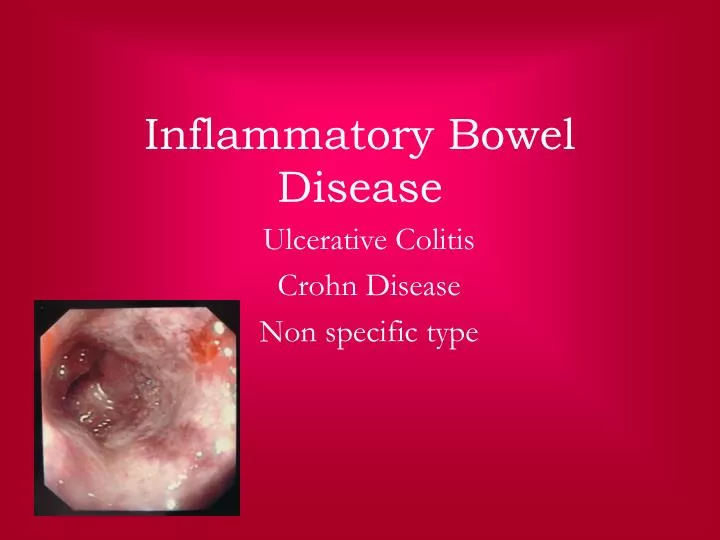 PPT  Inflammatory Bowel Disease PowerPoint Presentation, free download