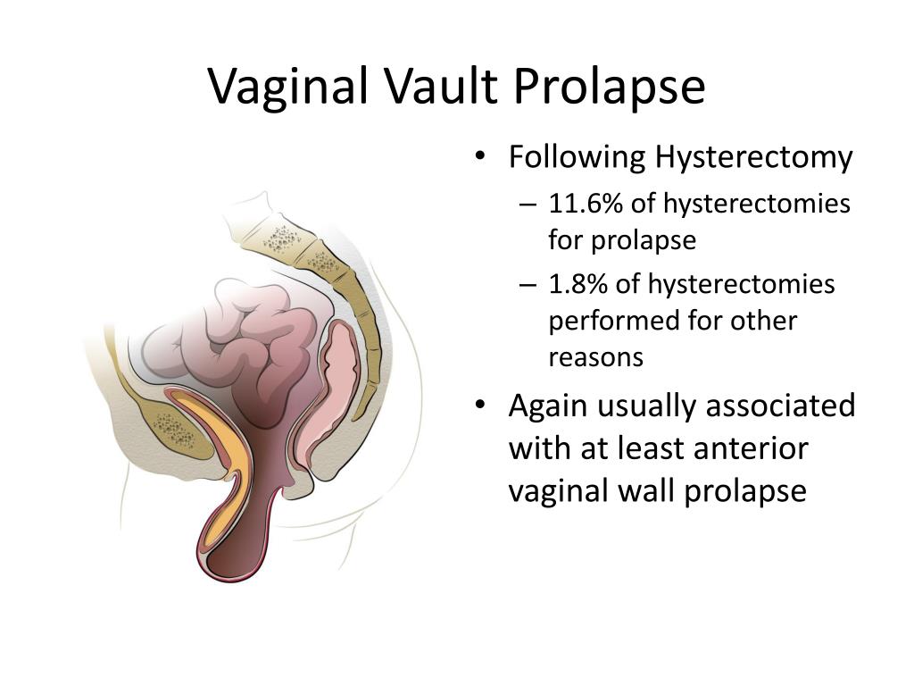 Ppt Female Pelvic Organ Prolapse Powerpoint Presentation Free