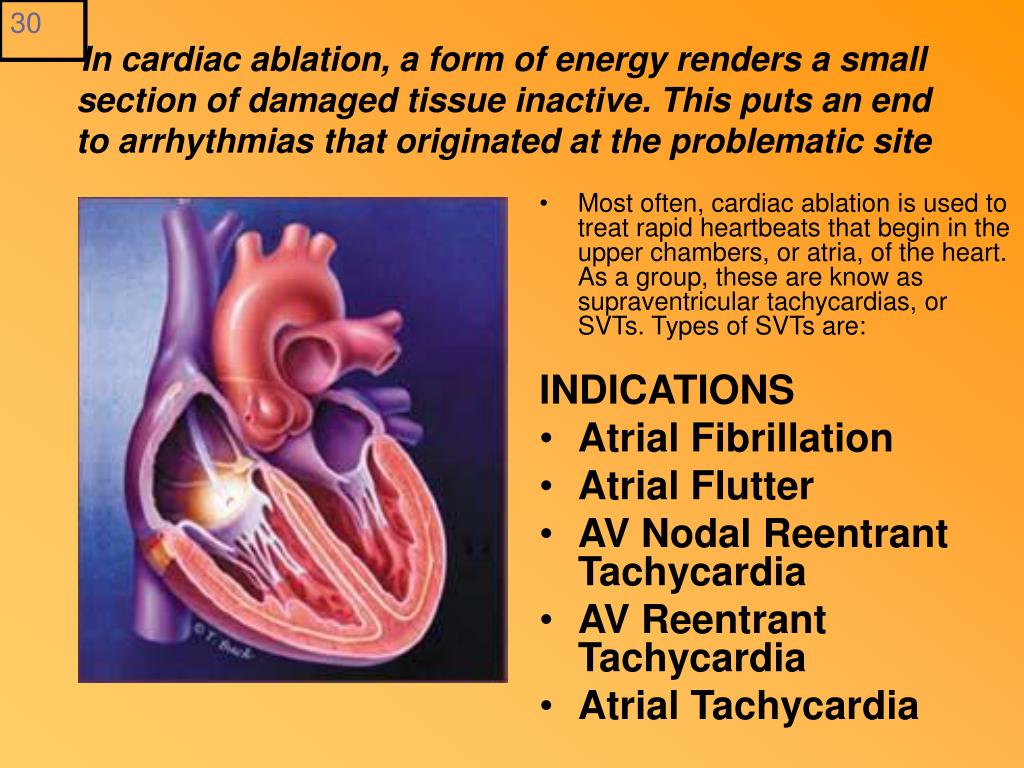 atrial flutter ablation indications atrial flutter ablation indications