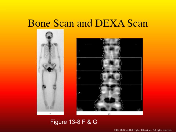 https://image.slideserve.com/1395072/bone-scan-and-dexa-scan-n.jpg
