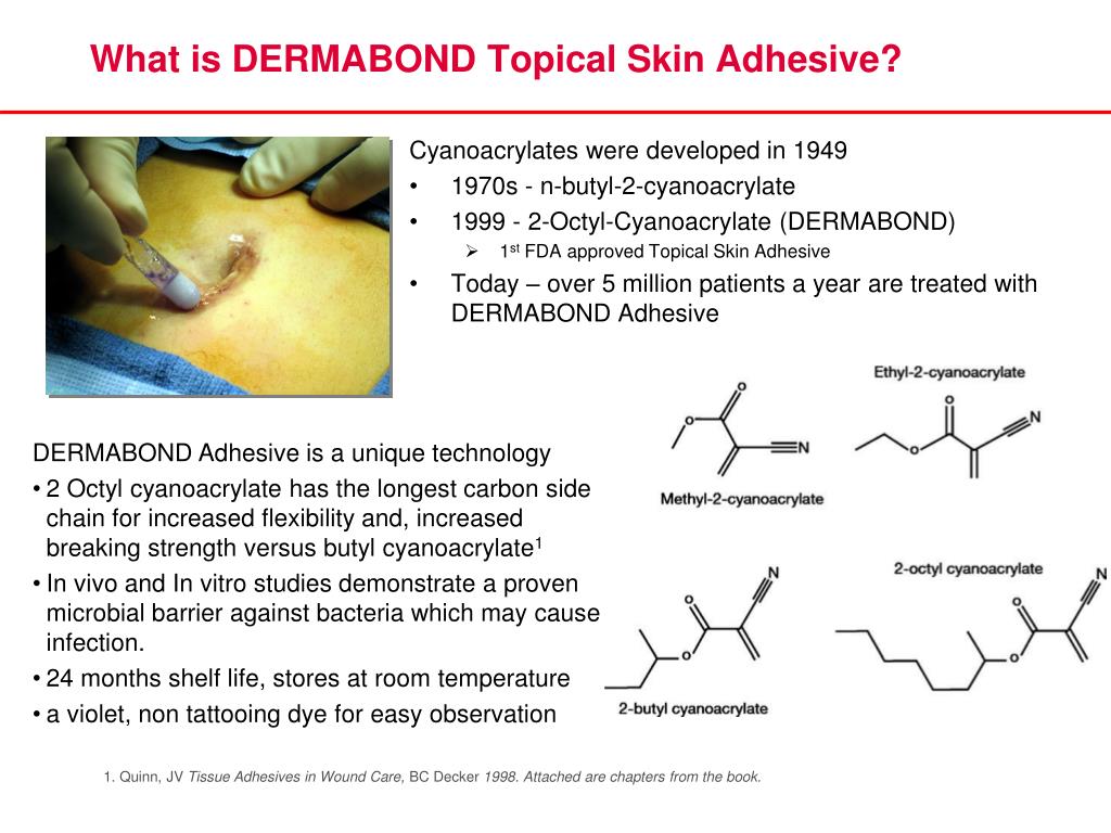 Dermabond (Topical Skin Adhesive 2-0ctyl Cyanoacrylate) at best