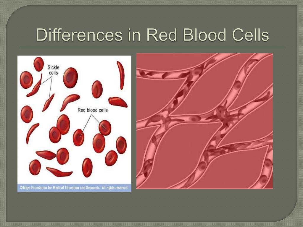 PPT - Sickle Cell Anemia PowerPoint Presentation, free ...