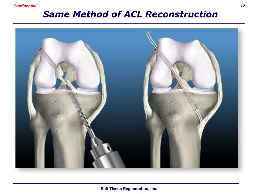 Связка мениска колена. Операция разрыв мениска и передней крестообразной связки. Разрыв ПКС коленного сустава. Операция ПКС коленного сустава.