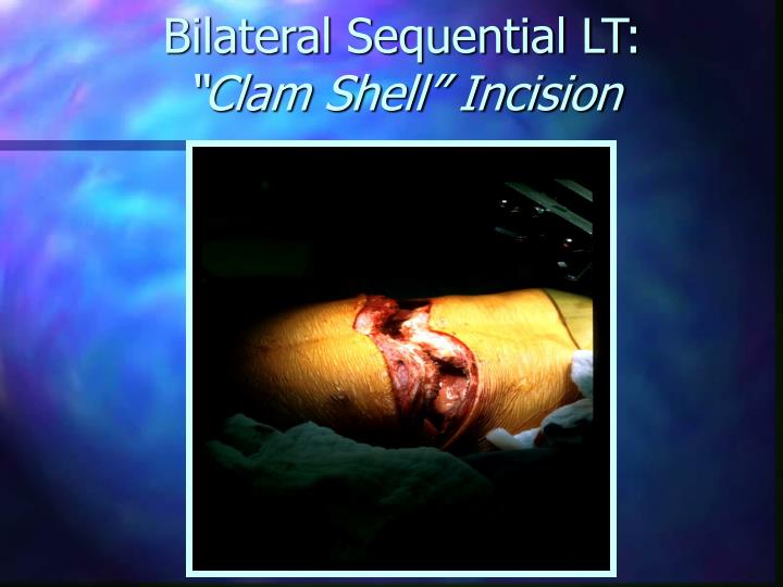 PPT - Lung Transplantation PowerPoint Presentation - ID 