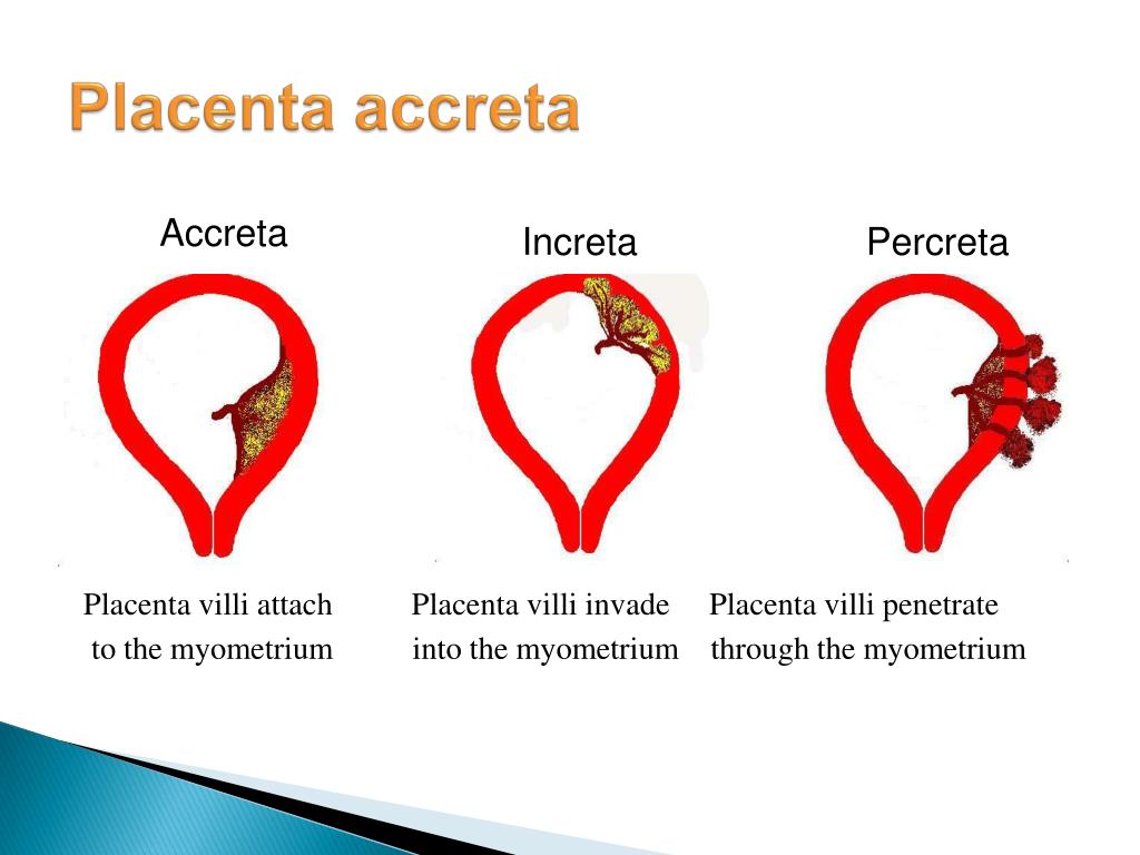 Difference between placenta accreta increta and percreta survivors successful forex trading strategies pdf viewer