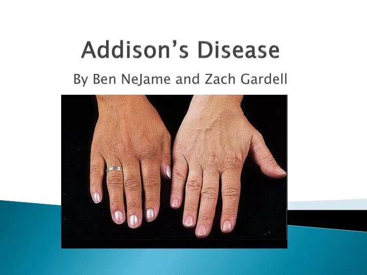 addisons disease skin