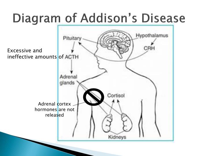 PPT Addison’s Disease PowerPoint Presentation ID1412672