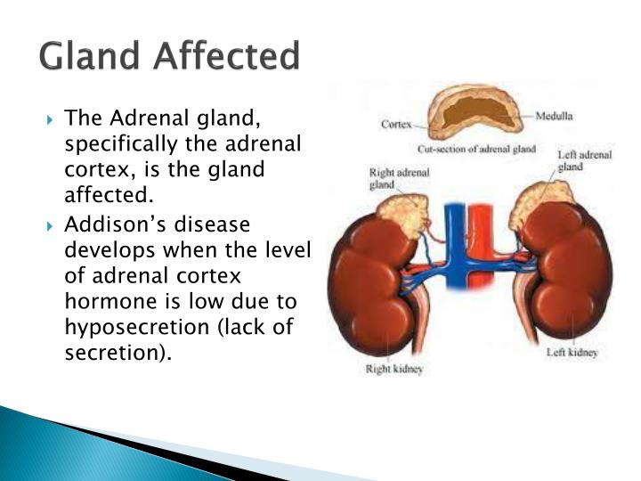 PPT Addison’s Disease PowerPoint Presentation ID1412672