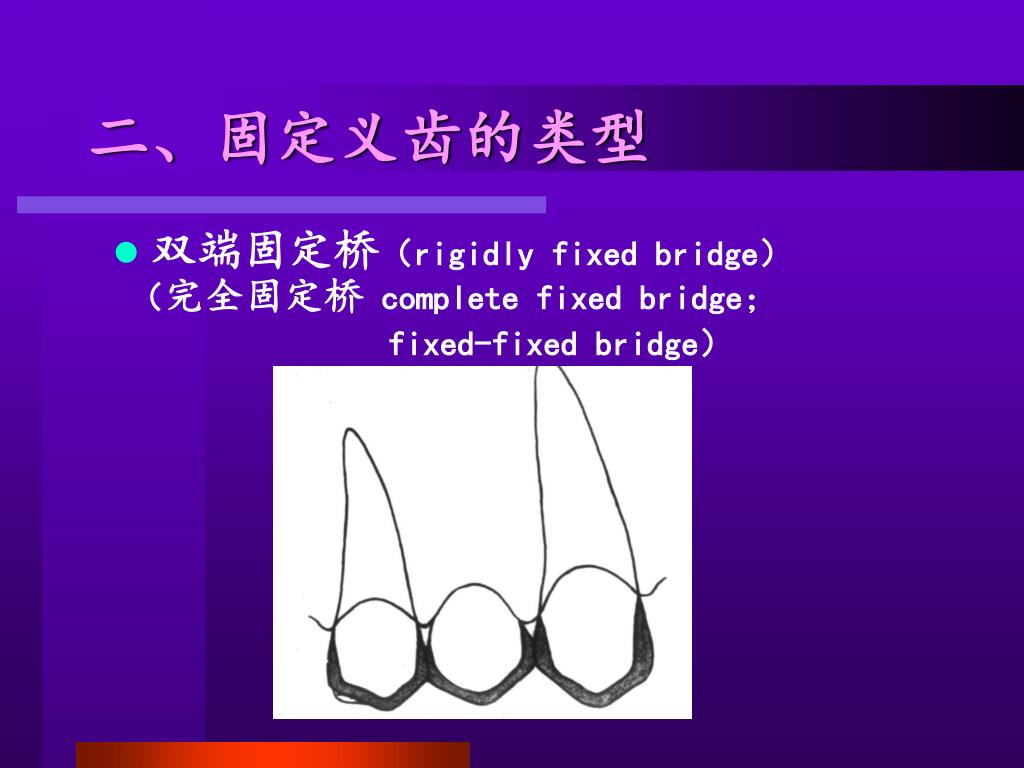 PPT - 第十三章 固定桥 Chapter four Fixed Partial Denture(Fixed bridge ...