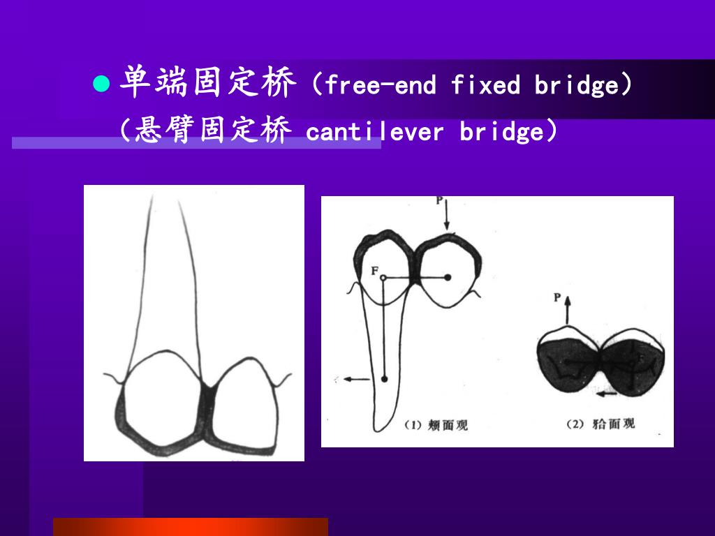 PPT - 第十三章 固定桥 Chapter four Fixed Partial Denture(Fixed bridge ...