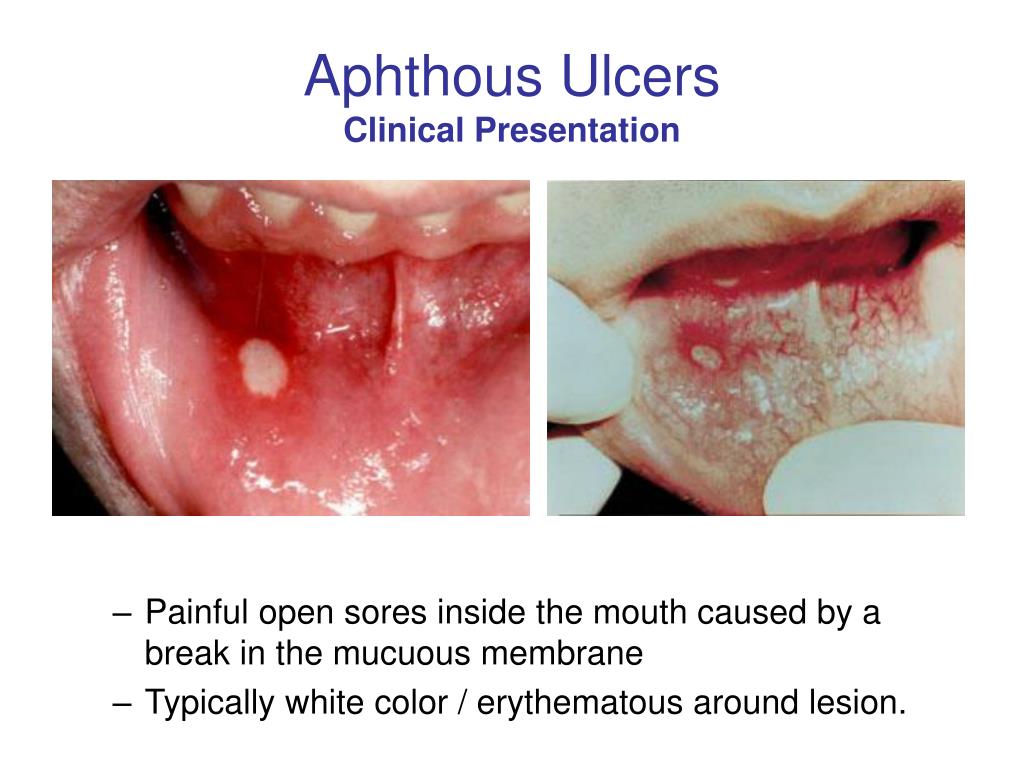 Ppt Oral Medicine Block Presentation Aphthous Ulcers Powerpoint