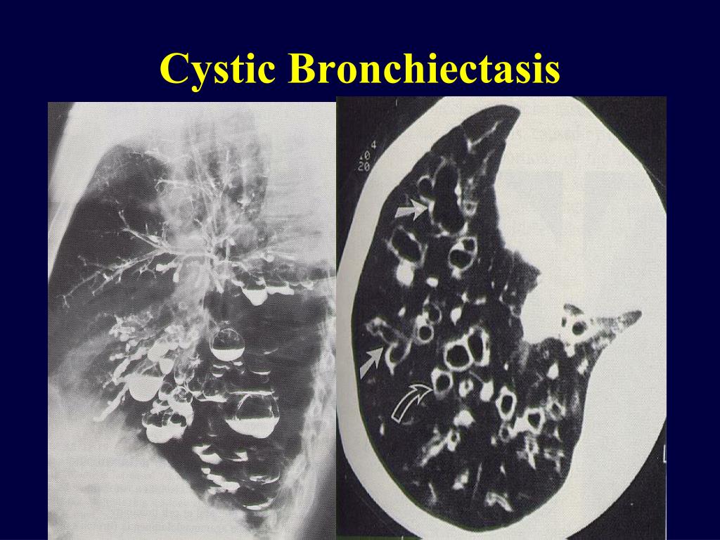 ILD in CXR