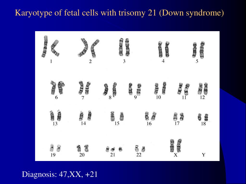 Синдром дауна по наследству. Down Syndrome karyotype. Синдром Дауна кариотип. Синдром Дауна хромосомы.