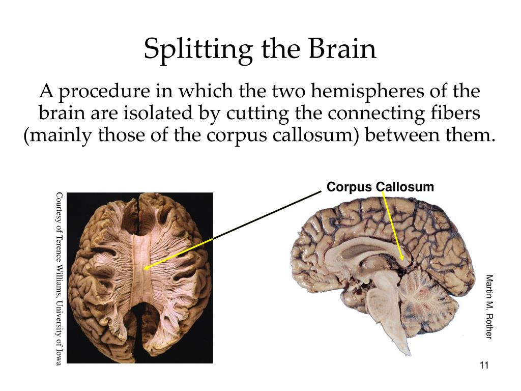 Split brain. Corpus callosum Fibers.