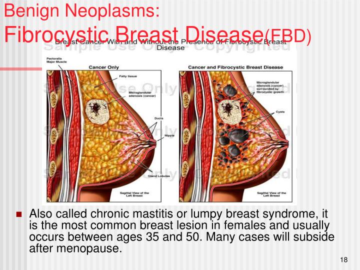 fibrocystic breast disease and breastfeeding Teen titan sex jinxed
