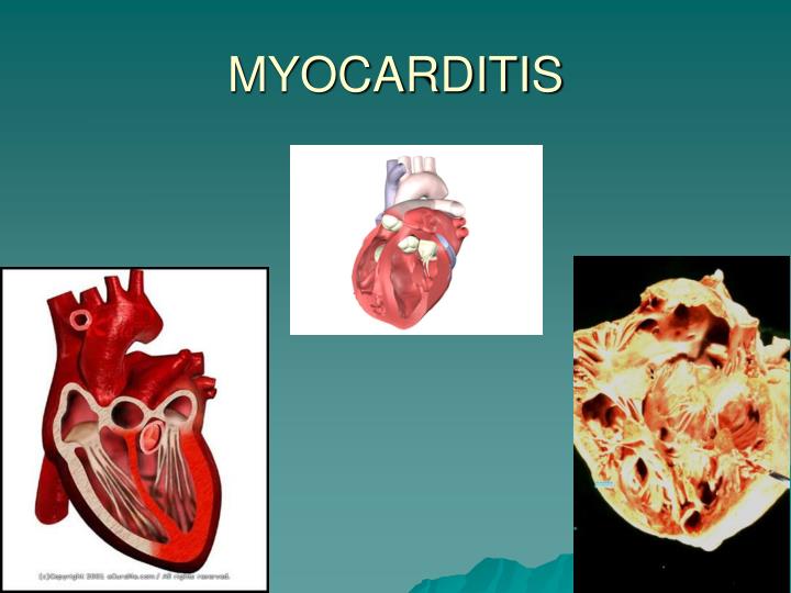 PPT - INFLAMMATORY CONDITIONS OF HEART PowerPoint Presentation - ID:1433221
